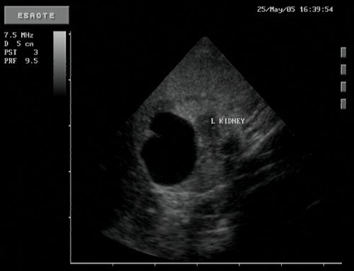 KidneyWithCyst