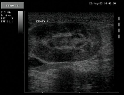 NormalKidney