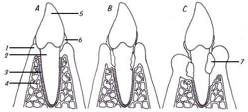 periodontitis